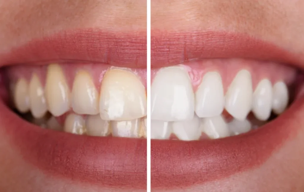 Blanqueamiento Dental: lo que Debes Saber - Odonto Ávila
