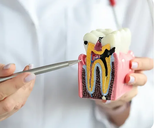 Endodoncia en Caracas Odonto Ávila