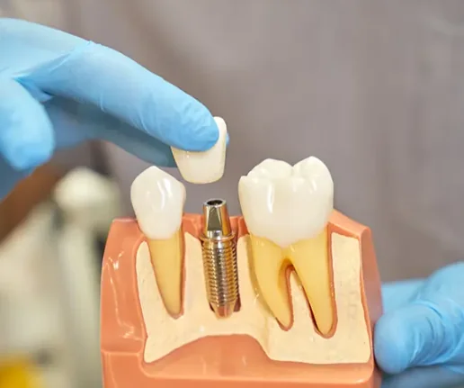 Implantes y Prótesis Dentales Caracas