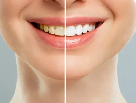 Limpieza y Estética Dental Caracas